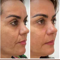 تخفیف لیزر موهای زائد تا آخر هفته  ۳۹۰ تومان|خدمات آرایشگری و زیبایی|کرج, گوهردشت|دیوار