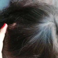 درمان قطعی شپش