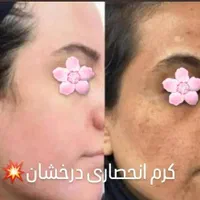کرم ضدلک و روشن کننده درخشان(بدون بازگشت)|آرایشی، بهداشتی، درمانی|شیراز, قصرالدشت|دیوار