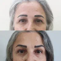 فیلر،بوتاکس،مزوژل جوانساز