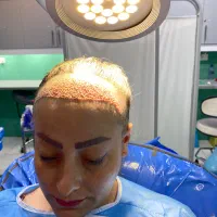 کاشت مو  و ابرو به روش سوپر fue پلاس(fue-sfue)|خدمات آرایشگری و زیبایی|شیراز, قدوسی غربی|دیوار