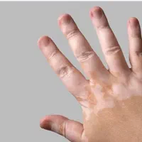 پیسی وویتیلیگو|آرایشی، بهداشتی، درمانی|تیکمه داش, |دیوار