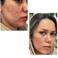 پاکسازی کبدچرب فقط در 40 روز