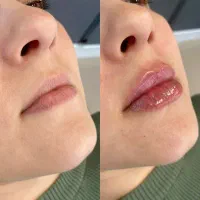 ژل ،بوتاکس،مزوتراپی مو، خال برداری ،لیزر مو|خدمات آرایشگری و زیبایی|اسلام‌شهر, باغ فیض|دیوار