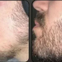 سرم گیاهی تضمینی  ریش وسبیل
