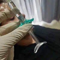 آف ویژه ژل بوتاکس مزو|خدمات آرایشگری و زیبایی|اسلامآباد غرب, |دیوار