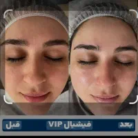 فیشیال صورت