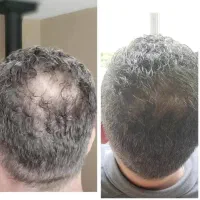 درمان تضمینی ریزش مو