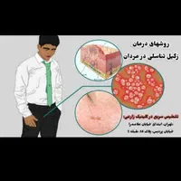 بهبود زگیل تناسلی