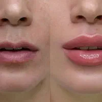 ژل فیلر بوتاکس مزو هایفو لیزر نخ|خدمات آرایشگری و زیبایی|اسلام‌شهر, باغ فیض|دیوار