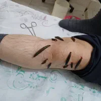 حجامت،زالو درمانی،نوین طب آریایی|خدمات آرایشگری و زیبایی|کرمانشاه, |دیوار