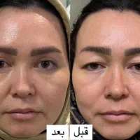 بلفاروپلاستی فقط با ۹ میلیون تومان در تهران