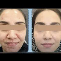 پوست صاف به خودت هدیه بده