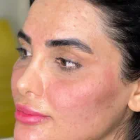 تزریقات فیلر صورت