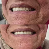 دندان مصنوعی تخصصی ژله ای،آلمانی|خدمات زیبایی و سلامت|کرج, گلشهر|دیوار