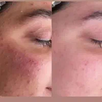 آموزش وخدمات فیشال،پی آرپی،مزوتراپی، مزونیدیلینگ|خدمات آرایشگری و زیبایی|کرج, گوهردشت|دیوار