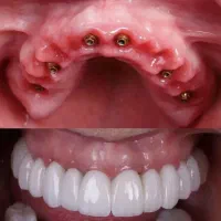 دندانپزشکی تخصصی،ایمپلنت فوری،اوردنچر،روکش