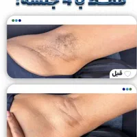 لیزر موج کندلا لیزر بانوان  لیزر آقایان لیزر خانم|خدمات آرایشگری و زیبایی|اصفهان, باغ زرشک|دیوار