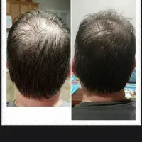 ریزش مو/رویش مجدد/رشد قدی مو /درمان کم پشتی مو|آرایشی، بهداشتی، درمانی|چاه داد خدا, |دیوار