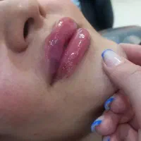 تزریق فیلر و بوتاکس