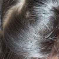 پاکسازی شپش