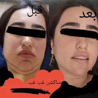 تزریق چربی صورت|خدمات آرایشگری و زیبایی|یاسوج, |دیوار