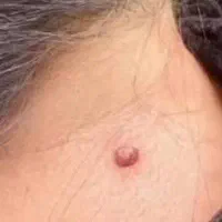خال پوستی وگوشتی وزیگیل|خدمات زیبایی و سلامت|کرمانشاه, |دیوار