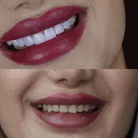 چشنواره‌پاییزه‌کامپوزیت‌ولمینت‌دندان‌