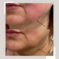 جشنواره هایفو ولیزر به مناسبت افتتاحیه ویلدا|خدمات آرایشگری و زیبایی|مشهد, آزادشهر|دیوار