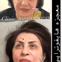 لیزر موهای زائد پی‌آر‌پی هایفو حجم‌سینه‌باسن لاغری|خدمات آرایشگری و زیبایی|تهران, صادقیه|دیوار