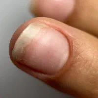 کاشت ناخن