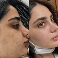 پاکسازی پوست صورت تخصصی (فیشیال vip)|خدمات آرایشگری و زیبایی|سنندج, |دیوار