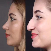 رینوپلاستی (جراحی/عمل بینی) و پیکر تراشی با تخفیف|خدمات آرایشگری و زیبایی|قزوین, |دیوار