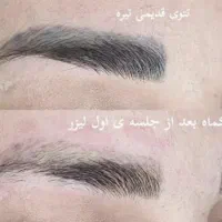 رفع تاتو و خالکوبی و تیرگی با لیزر