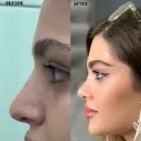 دنبال ی دکتر عالی برا عمل بینی گوشتی