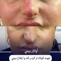 اقساط،لیفت بایوفیس صورت مزوژل بوتاکس اصلاح بینی نخ|خدمات زیبایی و سلامت|مشهد, احمدآباد|دیوار