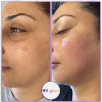 تکنیک بی بی گلو و مزونیدلینگ