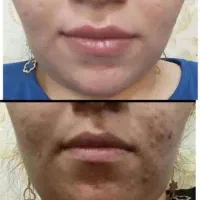 پوستت میخای بدون جوش ولک باشه بیا اینجا