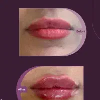 جشنواره ژل  بوتاکس و لیزر