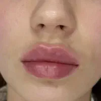 فیلر/بوتاکس /مزوتراپی/ جوانسازی