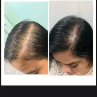 ریزش مو/رویش مجدد/رشد قدی مو /درمان کم پشتی مو|آرایشی، بهداشتی، درمانی|چاه داد خدا, |دیوار