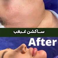 ساکشن غبغب و خدمات زیبایی با شرایط تمام اقساط|خدمات آرایشگری و زیبایی|تهران, شهرک غرب|دیوار