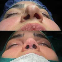 اف ویژه جراحی بینی در اهواز|خدمات آرایشگری و زیبایی|سوسنگرد, |دیوار