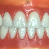 دندان مصنوعی ریف لاین