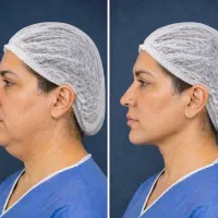 رفع و تخلیه غبغب ۷ م  + پی ار پی هدیه