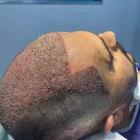 کاشت مو و ابرو اقساطی و تخفیف ویژه ۲۰درصدی