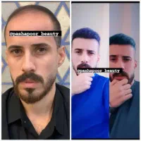 کاشت مو تخصصی|خدمات آرایشگری و زیبایی|پارس‌آباد, |دیوار