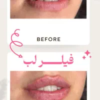 بوتاکس مصپورت ۹۹۰ هزار تومان مطب دکتر رویا طغیانی