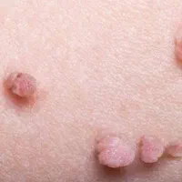 درمان زگیل پوستی/کرایو تراپی و لیزر/hpv|خدمات آرایشگری و زیبایی|اهواز, کیانپارس |دیوار