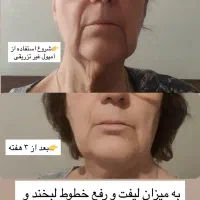 بدون تزریق وخونریزی جوان ترشو